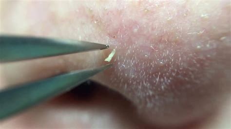 blackheads tweezers nose|More.